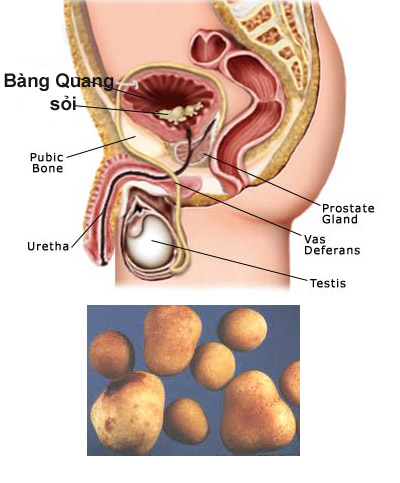 Bệnh tuyến tiền liệt – chớ coi thường!